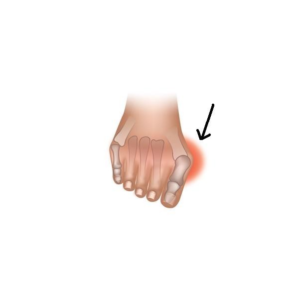 Bunga Bunion Gel Cushion SPORTS DE GLACE France